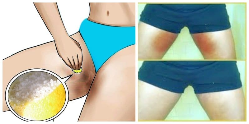 How to deal with inner thigh hyperpigmentation at home
